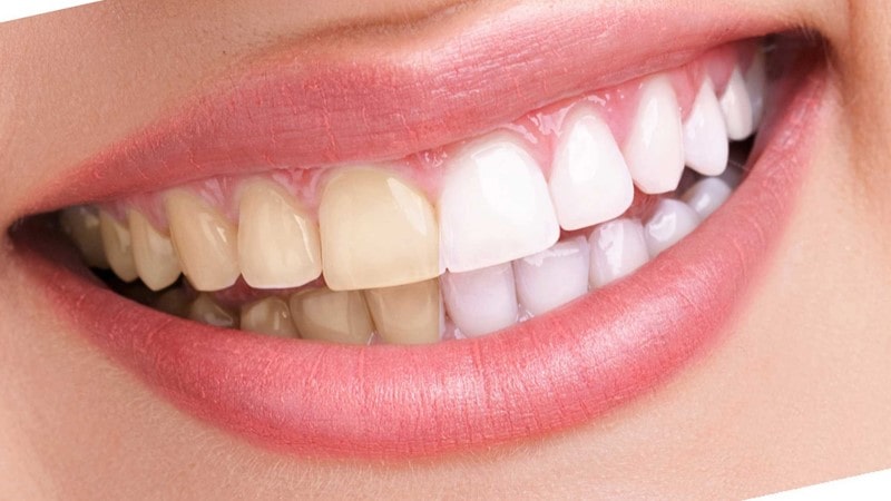 سفید کردن دندان‌ها