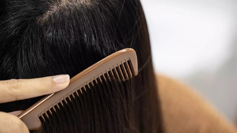 چربی بیش از حد مو می‌تواند باعث ریزش و نازک شدن مو شود