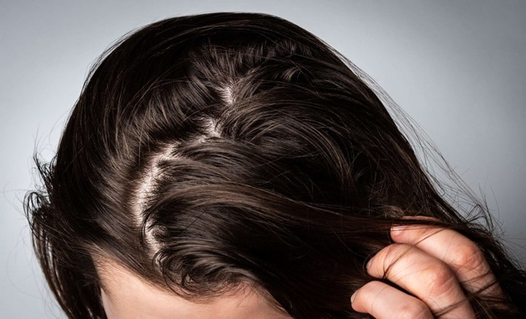 چربی بیش از حد مو می‌تواند باعث ریزش مو شود