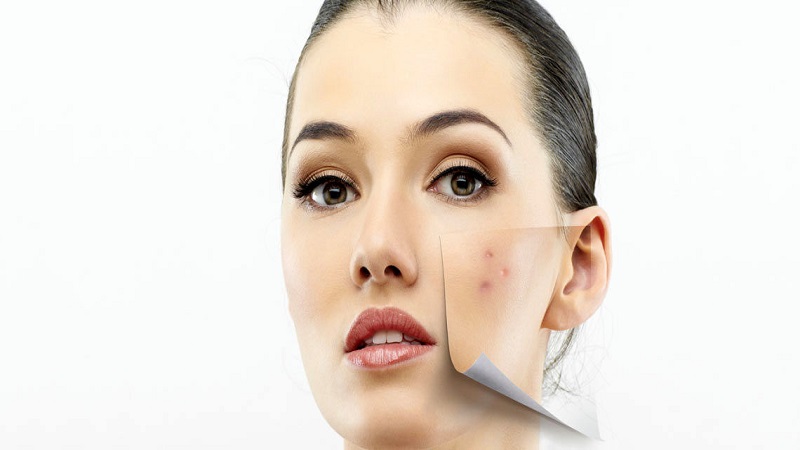  درمان لک صورت با لایه برداری شیمایی