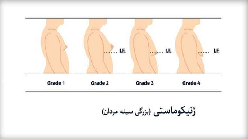 درمان ژنیکوماستی با ورزش