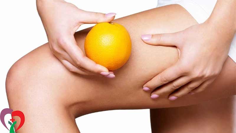 علت ایجاد سلولیت