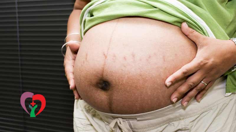 جلوگیری از ترک شکم در بارداری