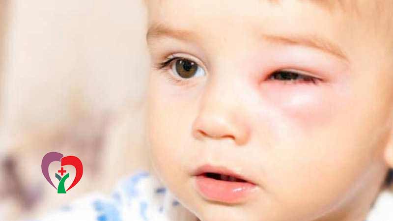 انواع عفونت چشم کودکان و بزرگسالان