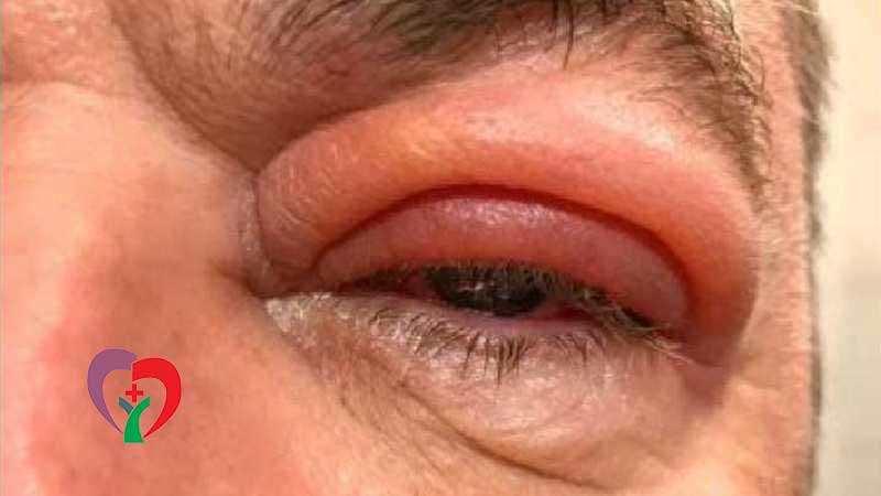  عفونت های قارچی چشم