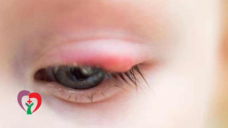  عفونت انگلی چشم