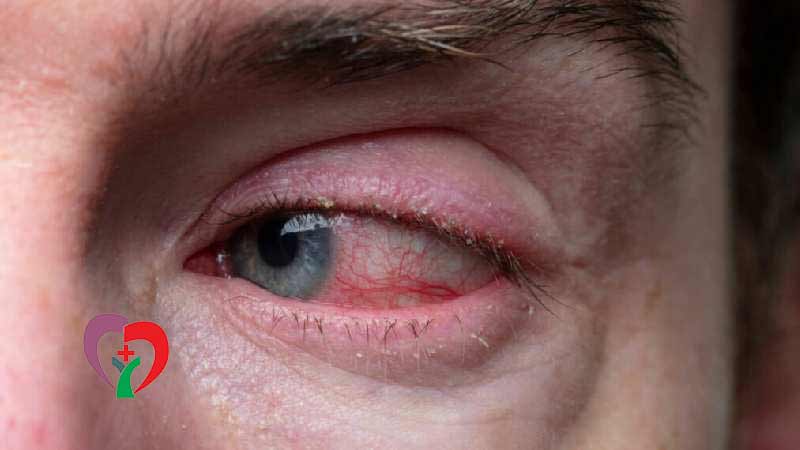  درمان عفونت های باکتریایی چشم