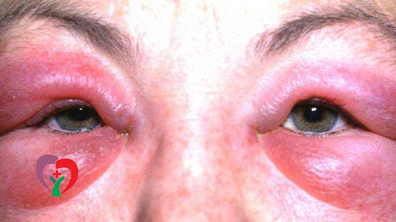 راه‌های پیشگیری از عفونت چشم