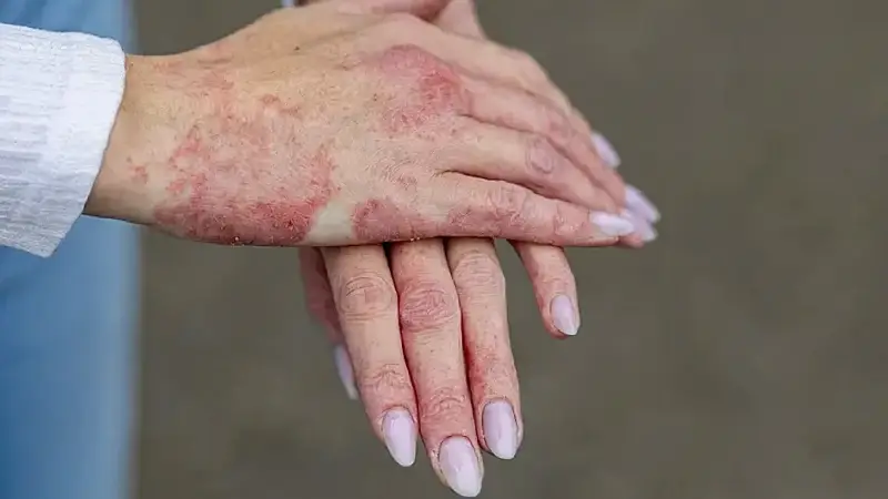 آلرژی پوستی