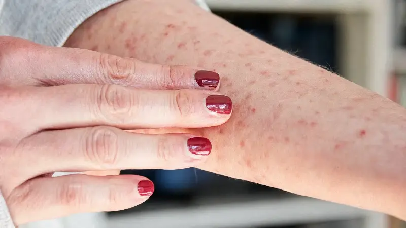 مراجعه به پزشک برای آلرژی پوستی