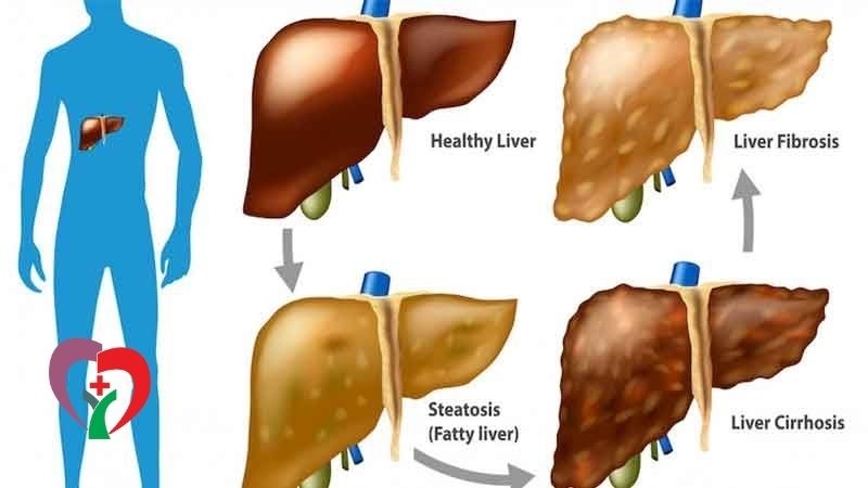 نشانه ها و علائم مشکلات کبدی چیست؟