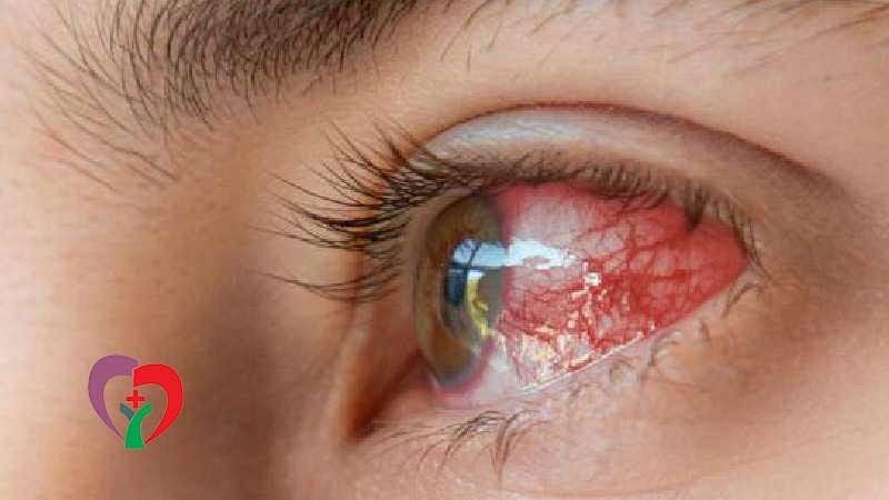 عفونت چشم از چیست؟