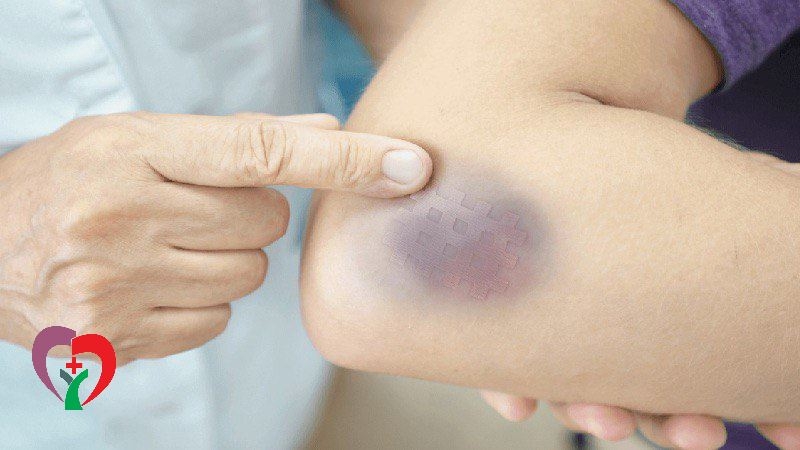 علت کبودی بی دلیل بدن